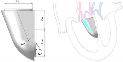 Numerical Simulation of the Influence of Geometric Configurations on Pressure Difference in the Intraventricular Tunnel